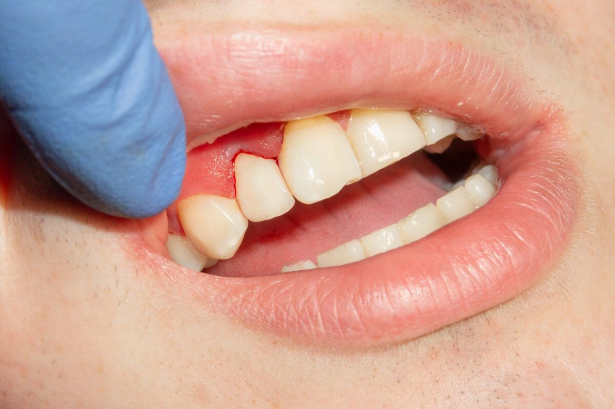 swelling gums in between teeth