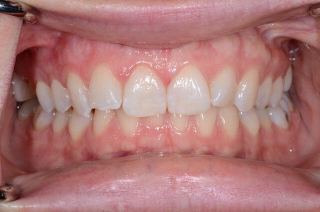 Dental Enamel Hypoplasia - Patient Image Copyright by Lakefront Family Dentistry