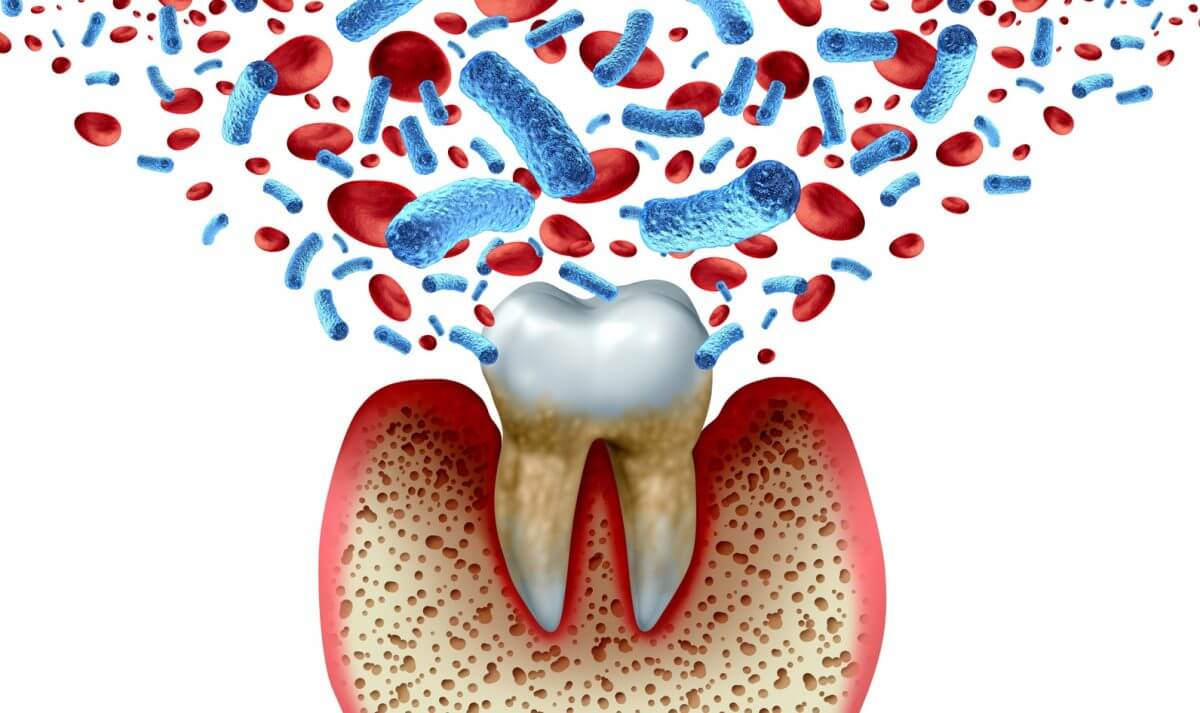 Fusobacterium Nucleatum is a Common Type of Bacteria in the Mouth that Can Be Harmful Under Certain Conditions if Left Unchecked.