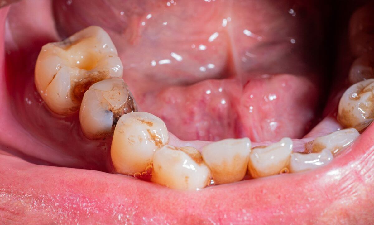 broken teeth and decay requiring immediate dental treatment.