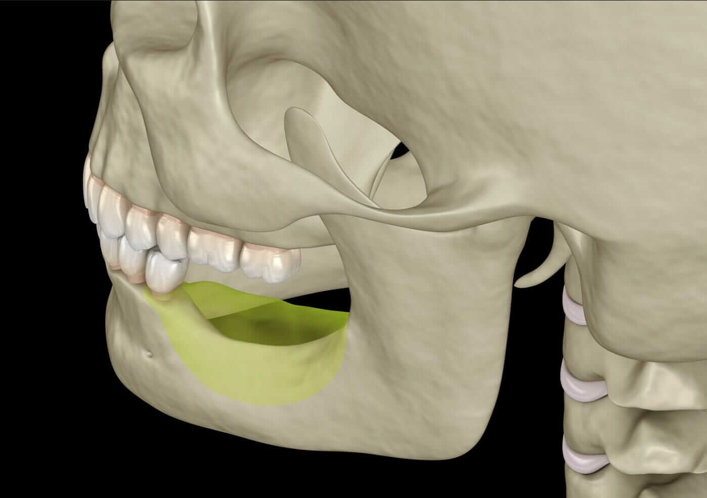 Resorption - Bone Resorption - Jaw Bone & Tooth Loss Treatment