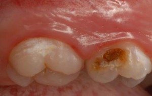 tooth rot