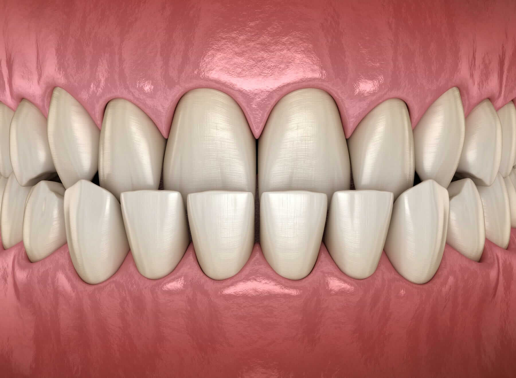 Contact Us for Underbite Correction with Invisalign