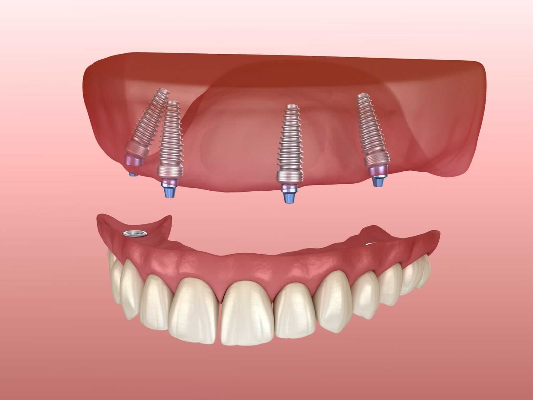 upper dental bridge with implants dentist to make life healthier and eating is easier