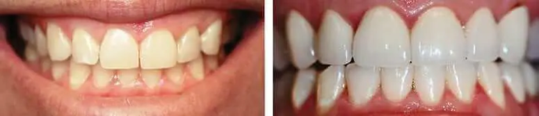 CEREC Veneers on Uppers and Lowers