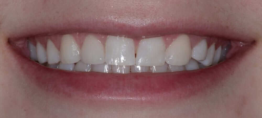 Before and After Cosmetic Dentistry Photos, Lakefront Family Dentistry