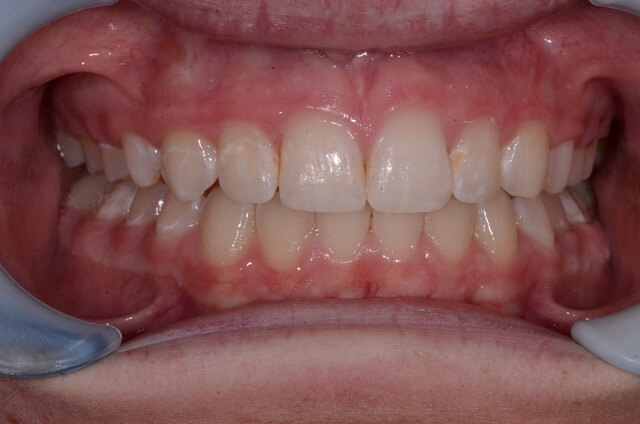 Dental Enamel Hypoplasia - Patient Image Copyright by Lakefront Family Dentistry