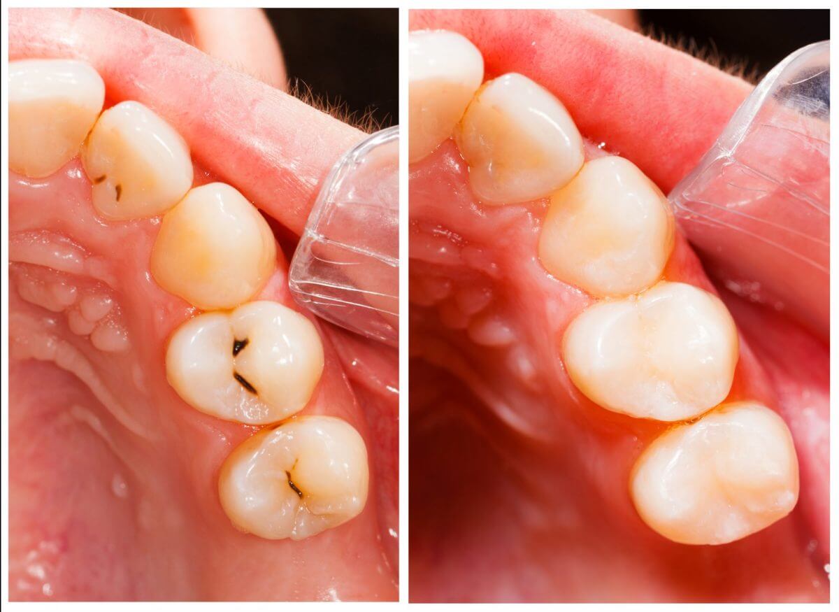 Dental Cavity Before and After Treatment