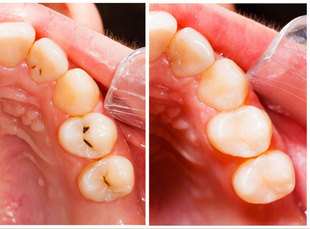 white tooth filling