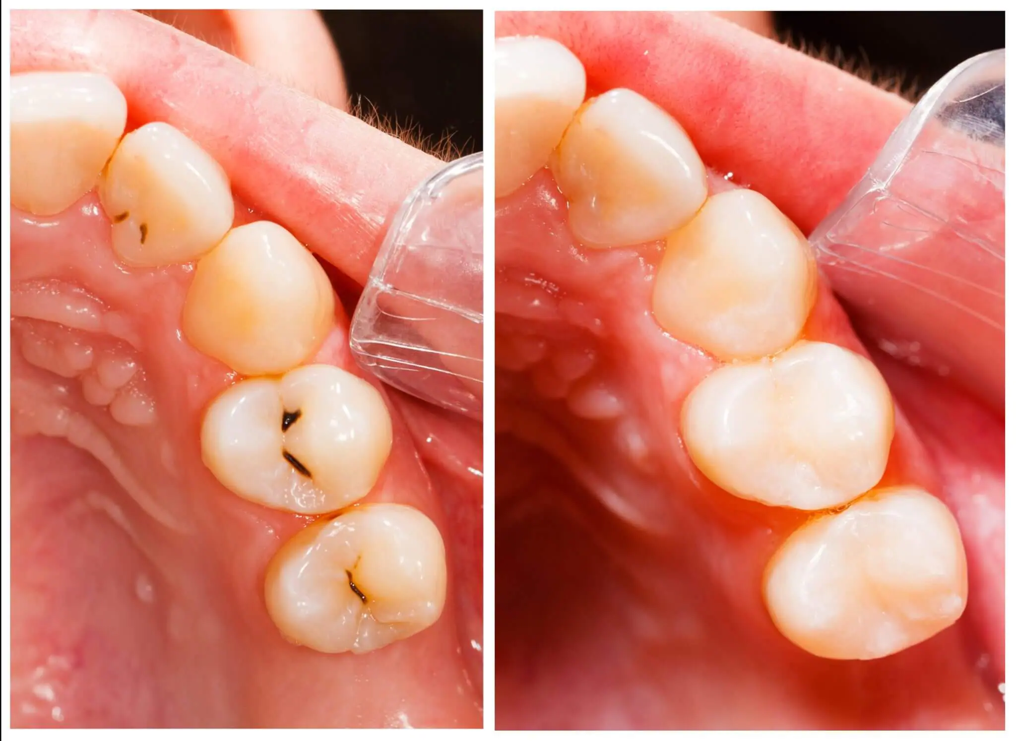 White Fillings, Tooth Filling