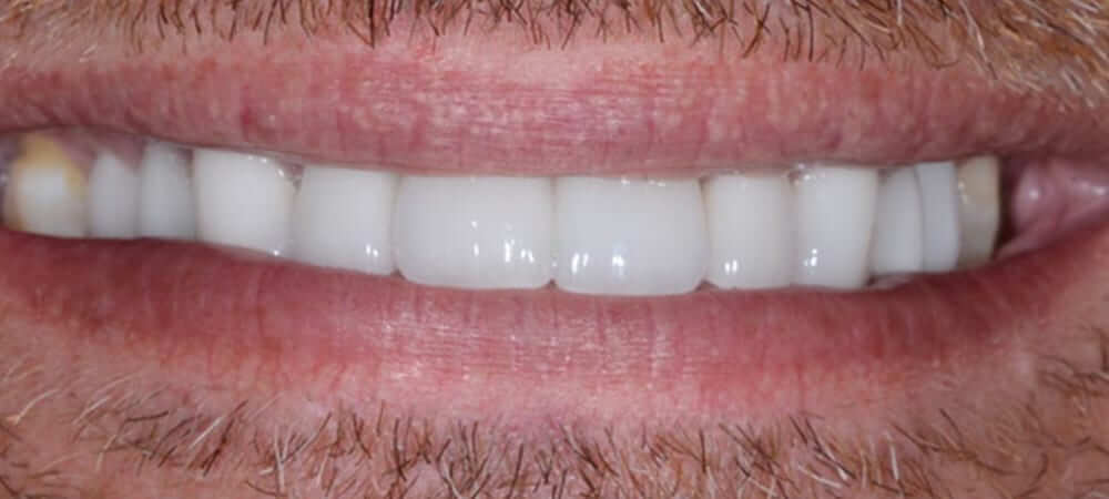 Same Day Dentistry with CEREC Crown. Top Dentists, Dr. Mark Phillipe, DDS, and Dr. Derek Hauser, DDS.