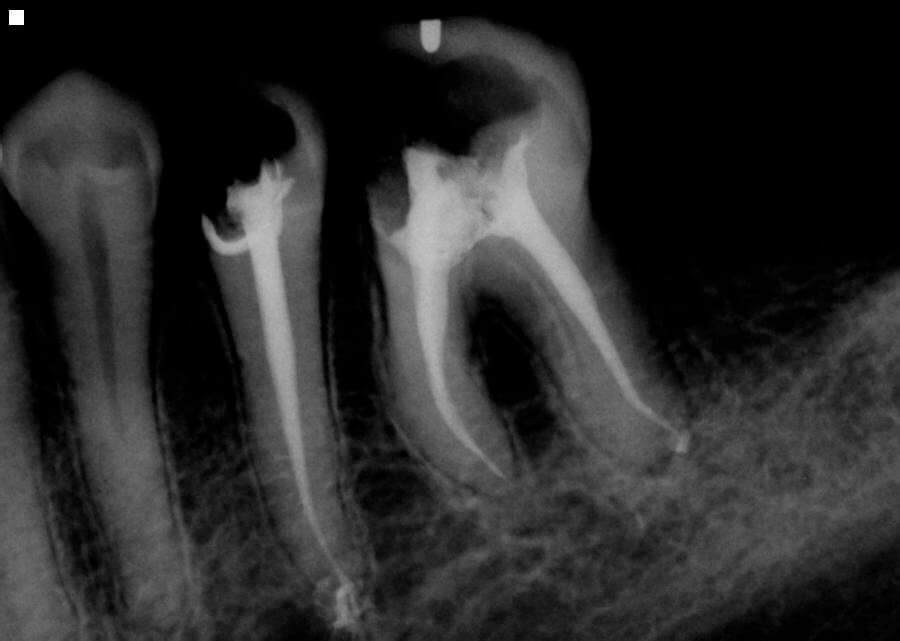 This is after a root canal is completed on two teeth as seen in digital x ray.