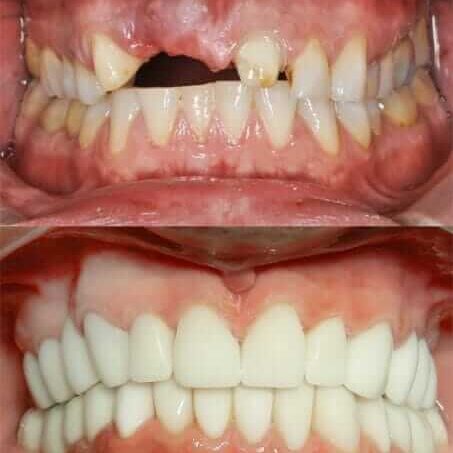 Tooth Extractions, Dental Implants, CEREC Crowns, Teeth Whitening
