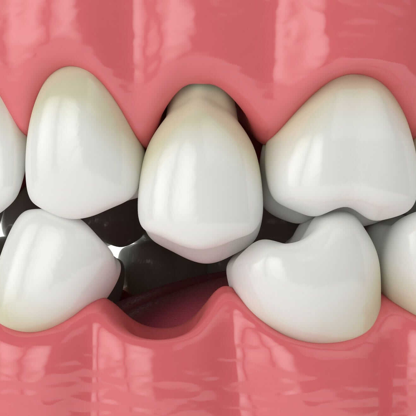 Root Canal Treatment at Lakefront Family Dentistry