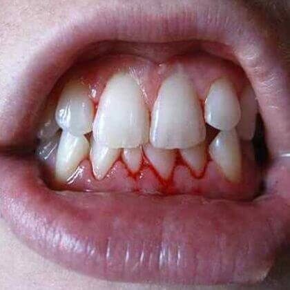 Swollen Gums and How to Stop Bleeding Gums