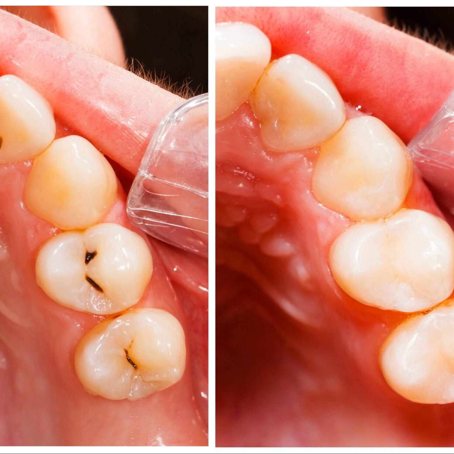 white tooth filling