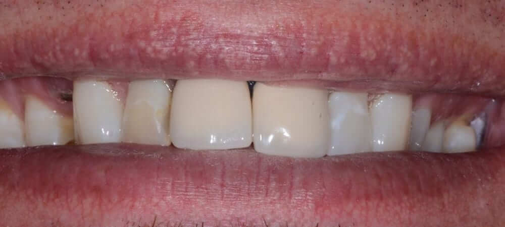 Discolored Teeth Replaced witih CEREC Crowns with Top Cosmetic Dentists at Lakefront Family Dentistry