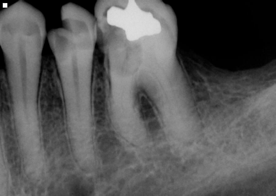 Periapical abscess is a dental abscess. This is before a root canal on left mandibular with digital x ray.