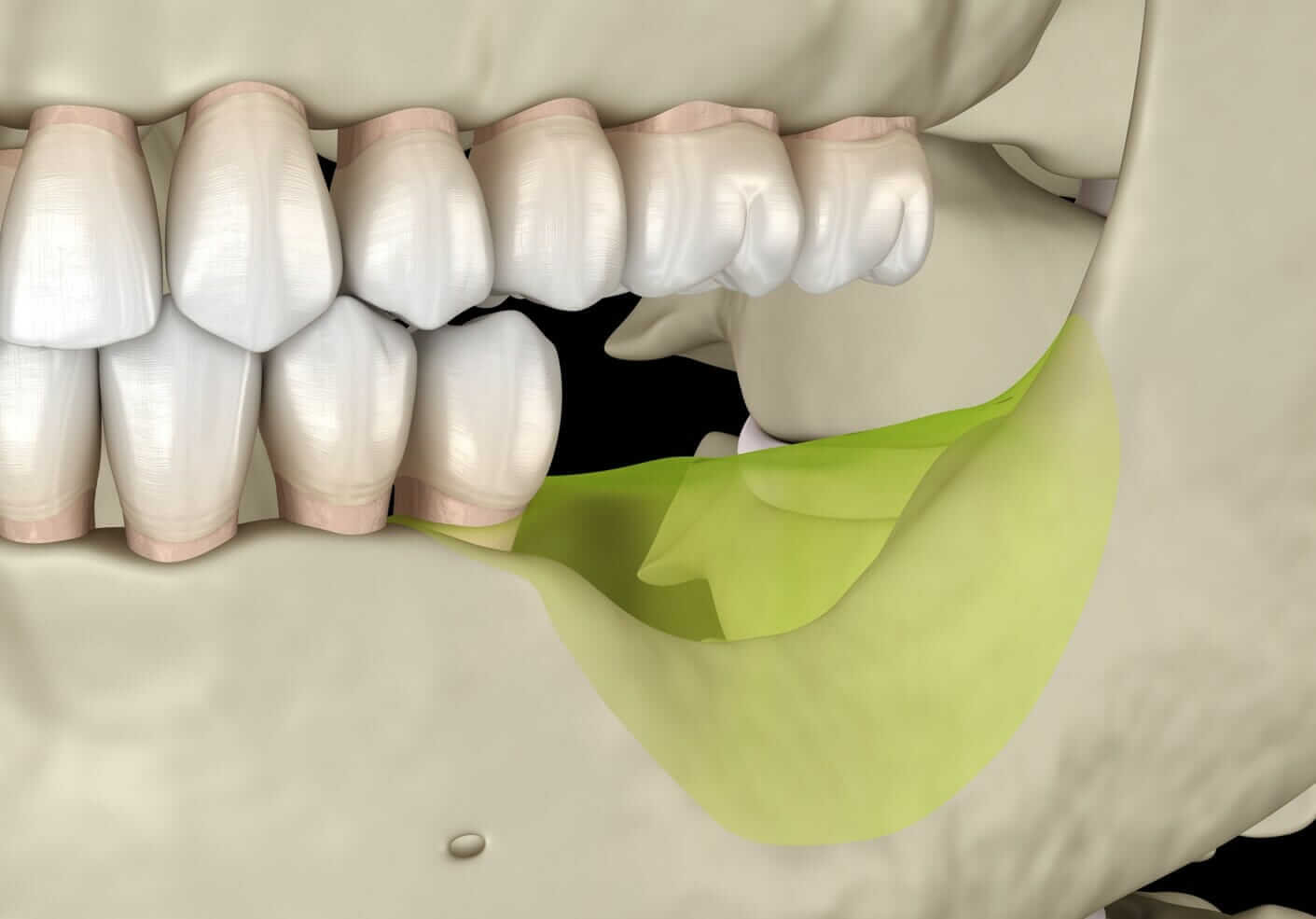 Jaw Bone Resorption
