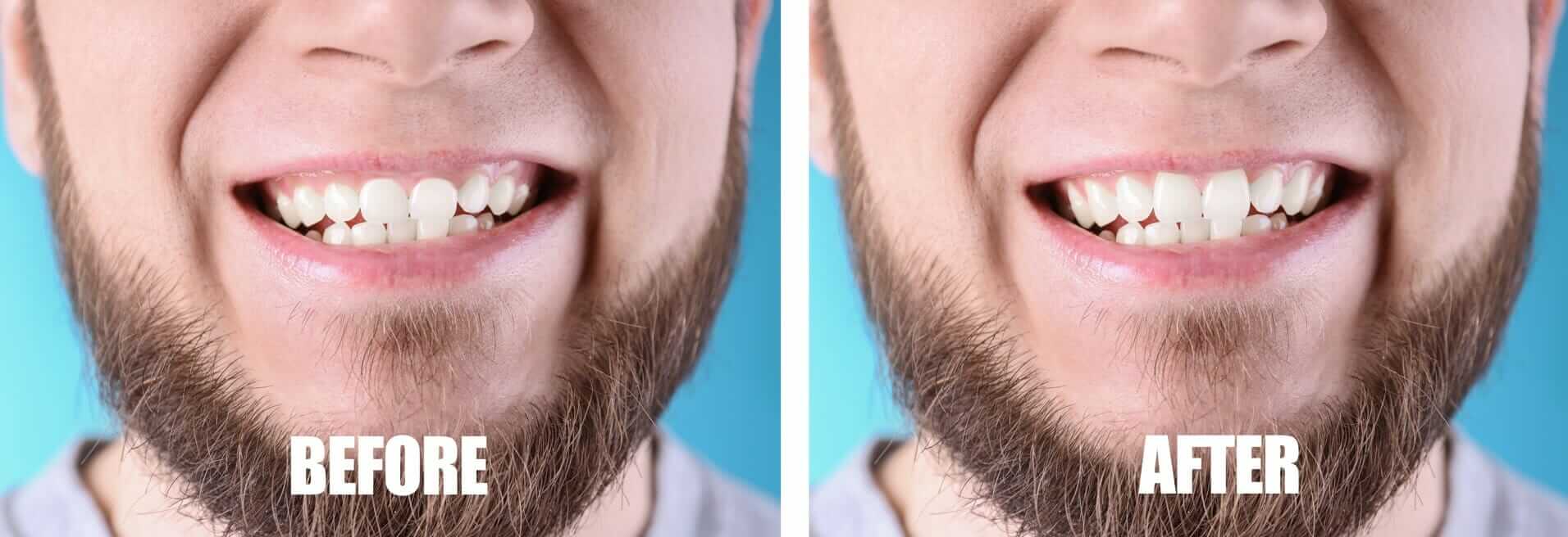 botox for gummy smile