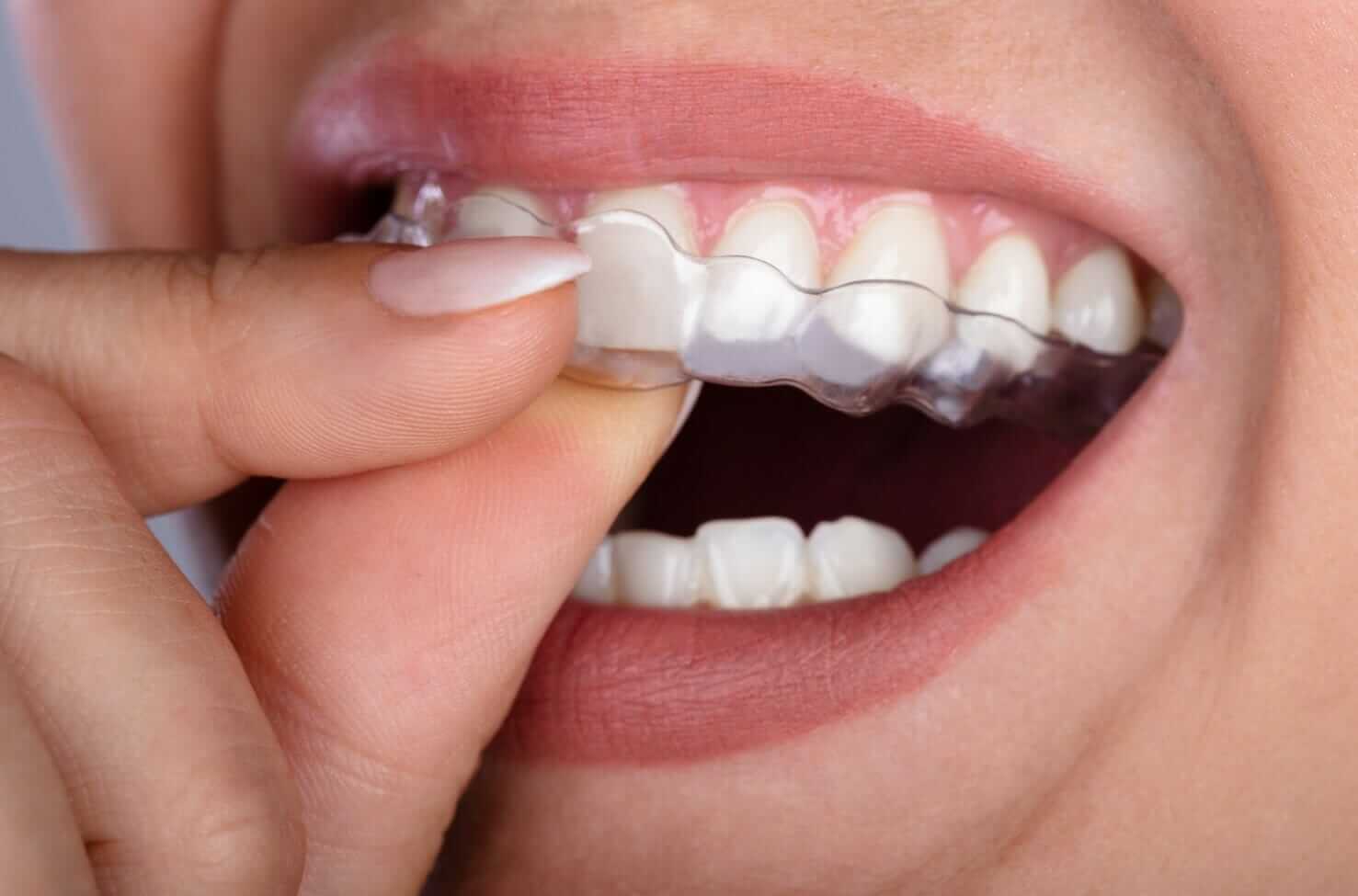 bruxism mouth guard