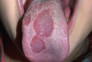 Example of Burning Mouth Syndrome Effect on Tongue Example of Burning Mouth Syndrome Effect on Tongue