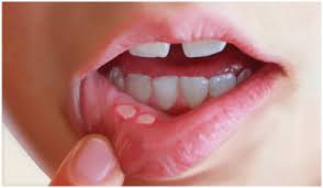 canker sore