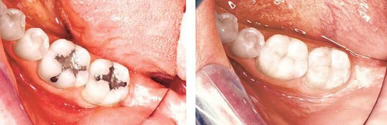 CEREC Inlays