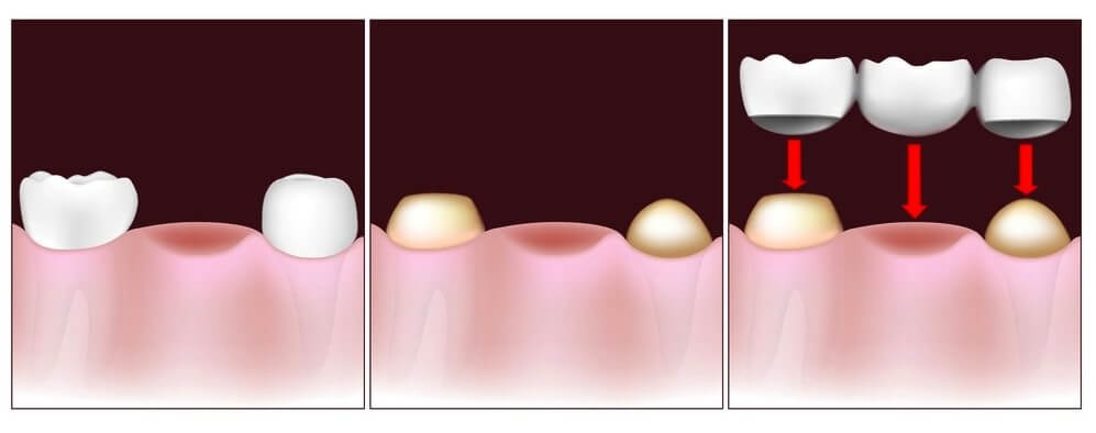 dental bridge