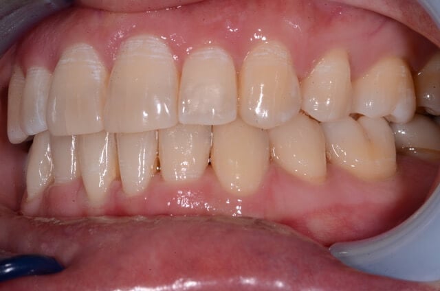 Dental Enamel Hypoplasia - Patient Image Copyright by Lakefront Family Dentistry