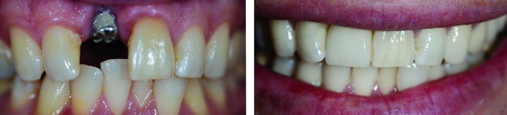 Titanium Dental Implant with CEREC Porcelain Crowns and Veneers