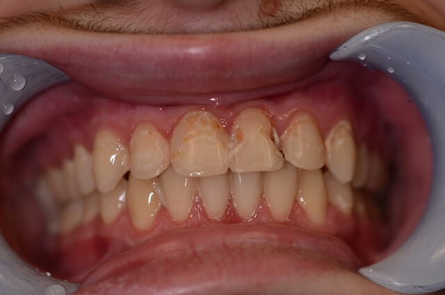dental enamel hypoplasia - enamel erosion treatment