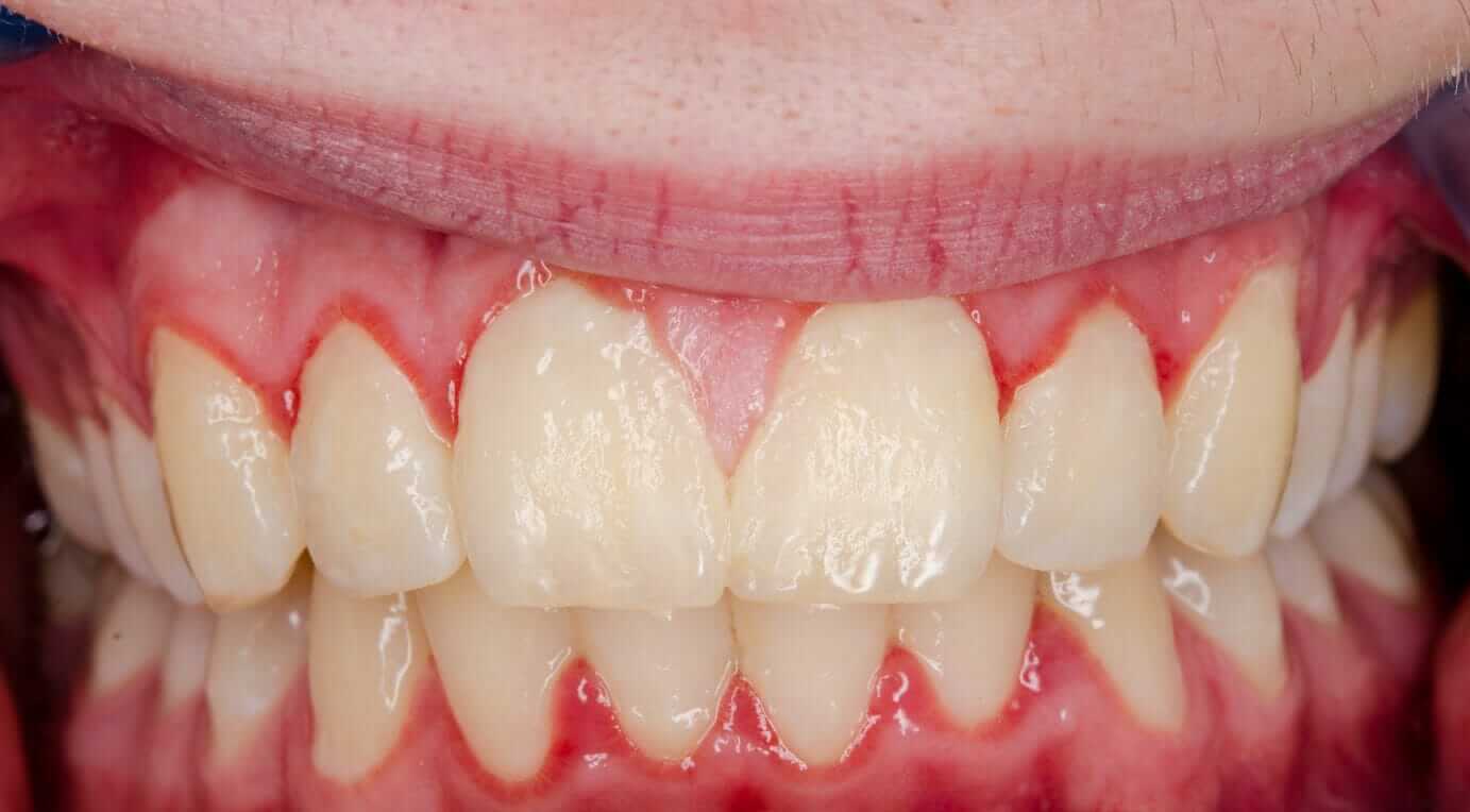 Gingivitis Hyperplasia Gingivitis Hyperplasia