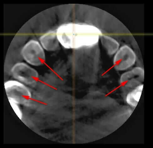 Internal Tooth Resorption