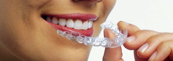 Invisalign Treatment for Malocclusions