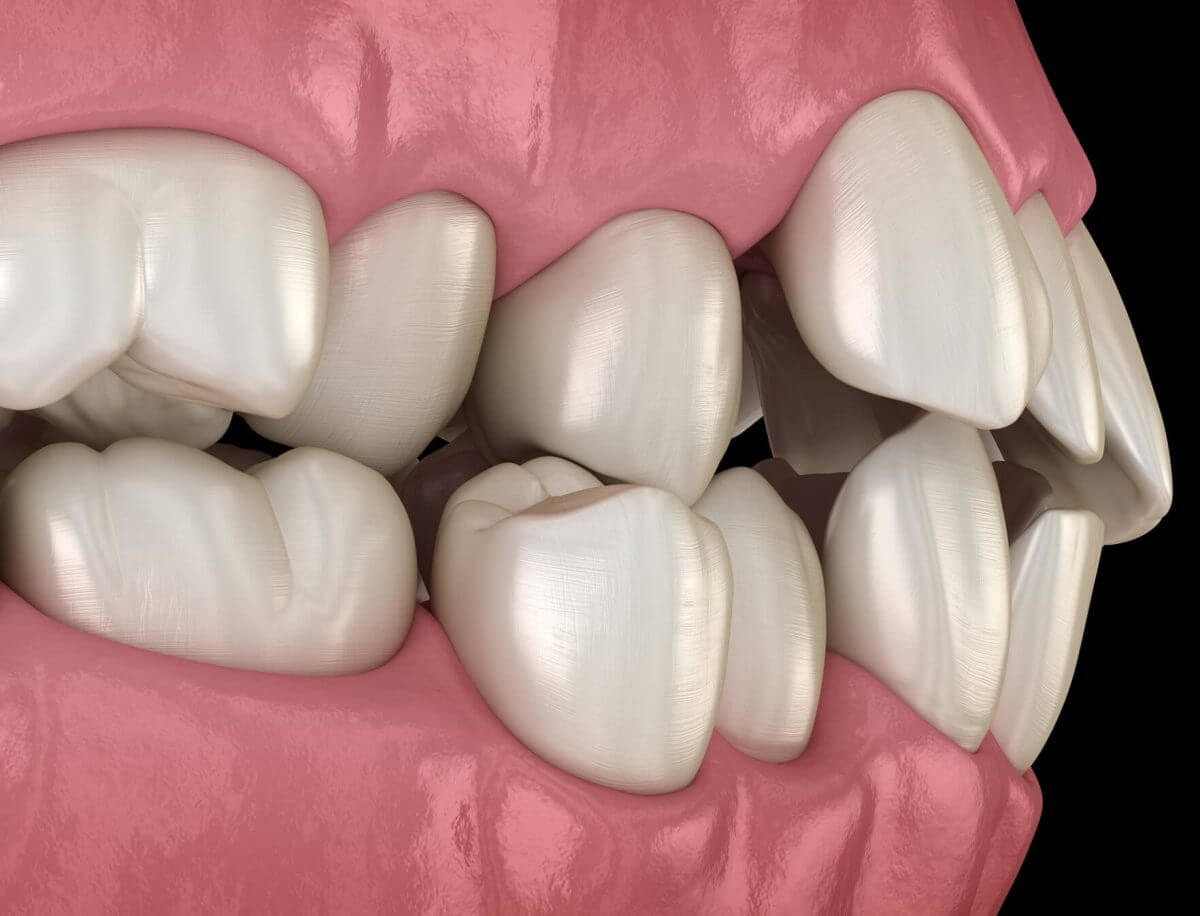 rotated teeth