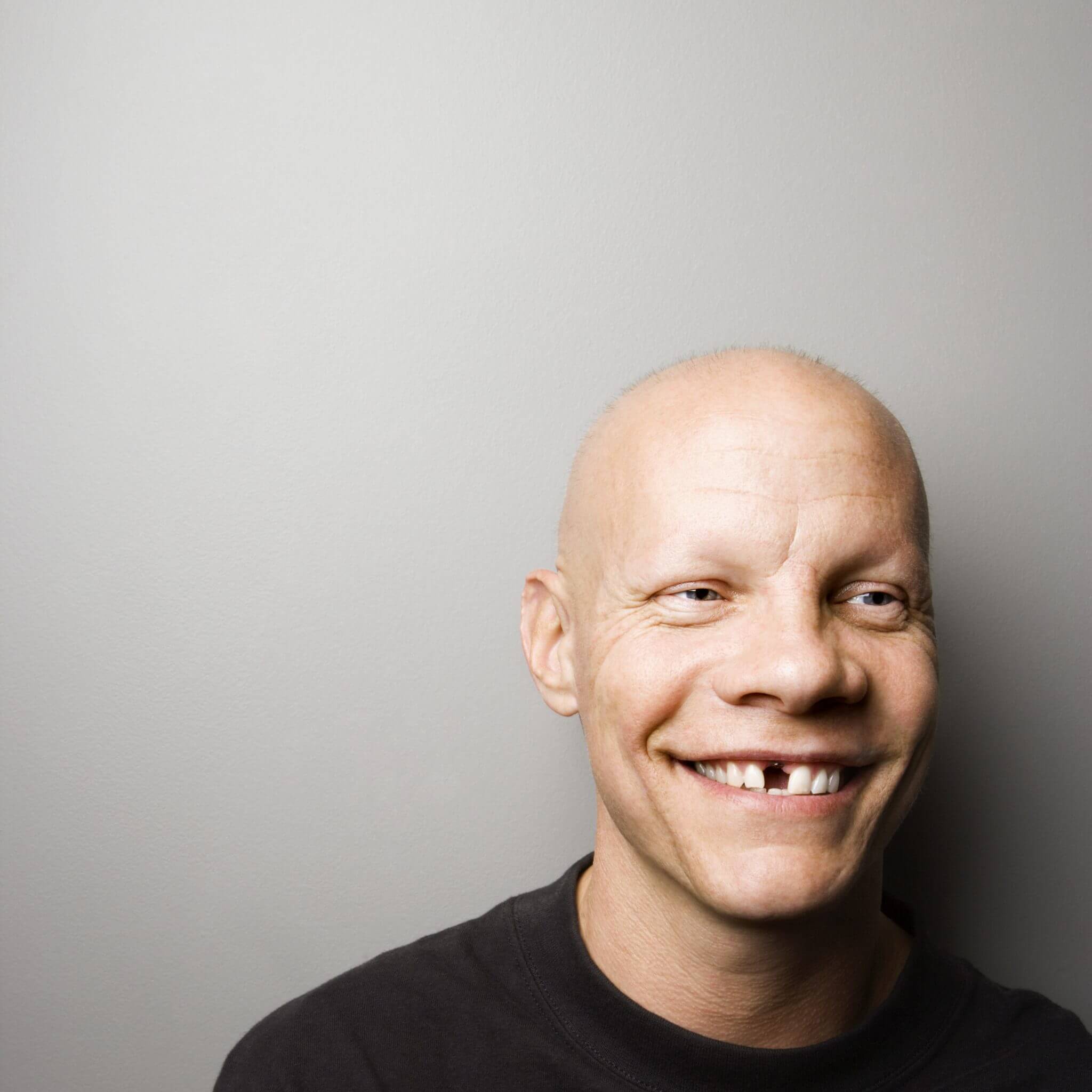 missing teeth, cerec crown, dental implant, lakefront family dentistry