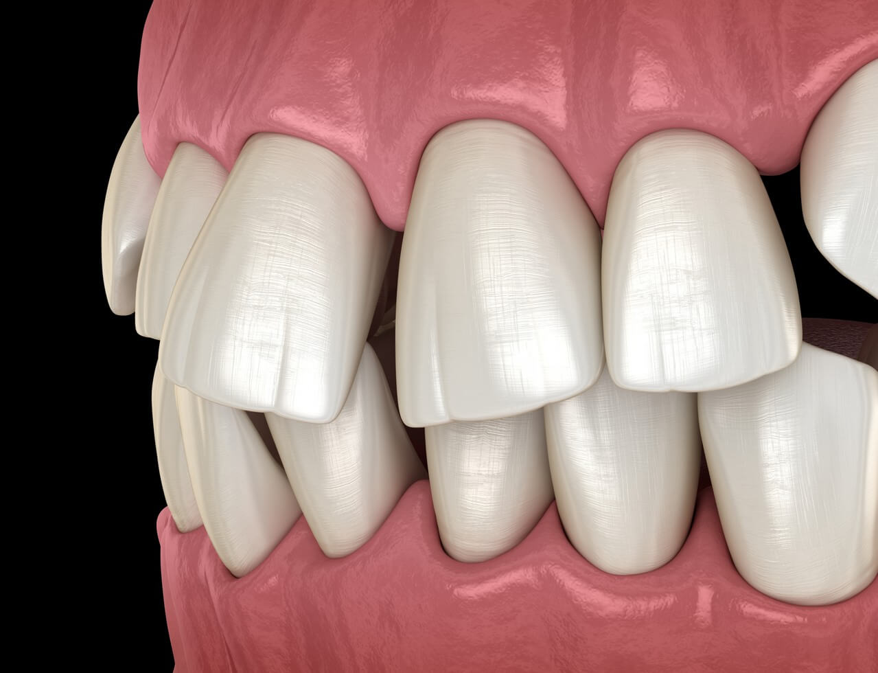 Treating Adults with Crowded Teeth for Better Overall Health