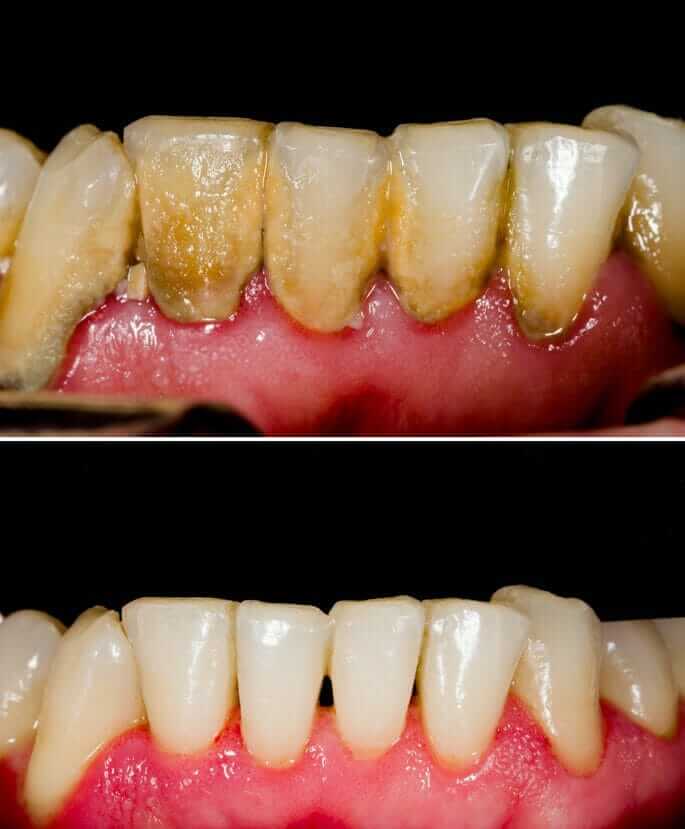periodontal disease symptoms and treatment dentist