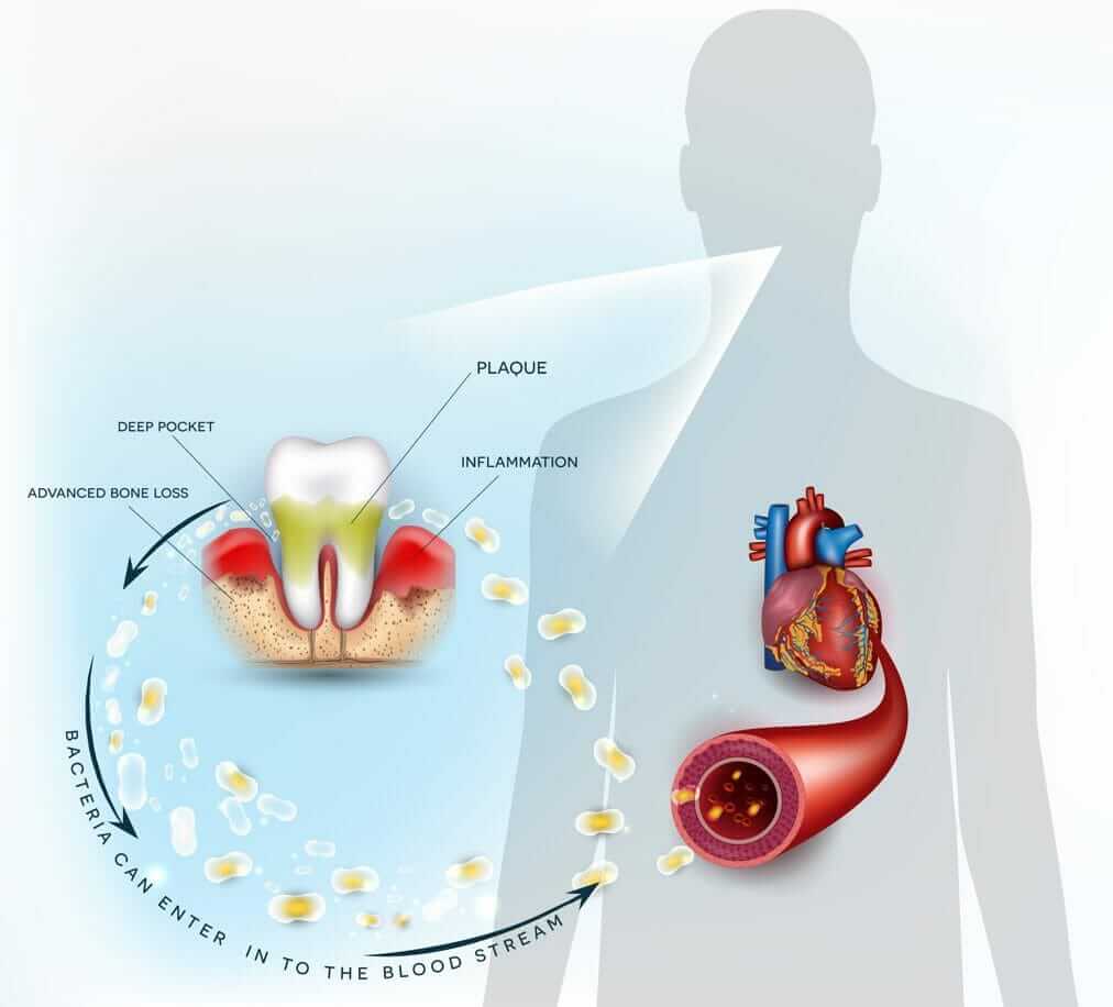 Plaque and Bacteria Enter the Bloodstream from Gum Disease and Periodontitis, Possibly Causing a Heart Attack or Stroke. Make Sure and Get Your Professional, Biannual Teeth Cleaning.