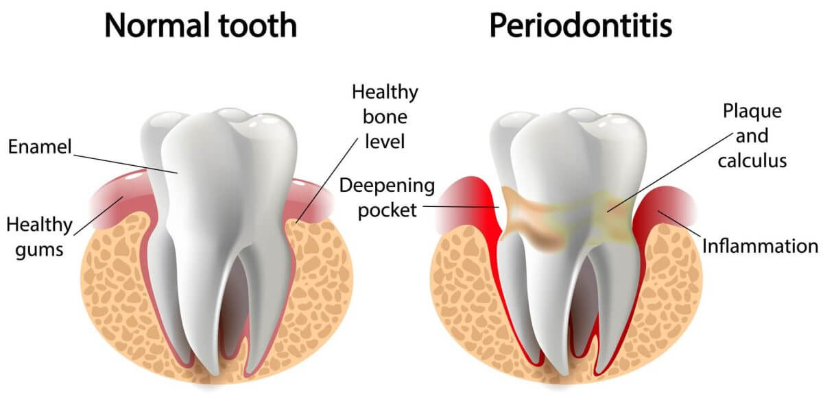 periodontitis tooth inflammation