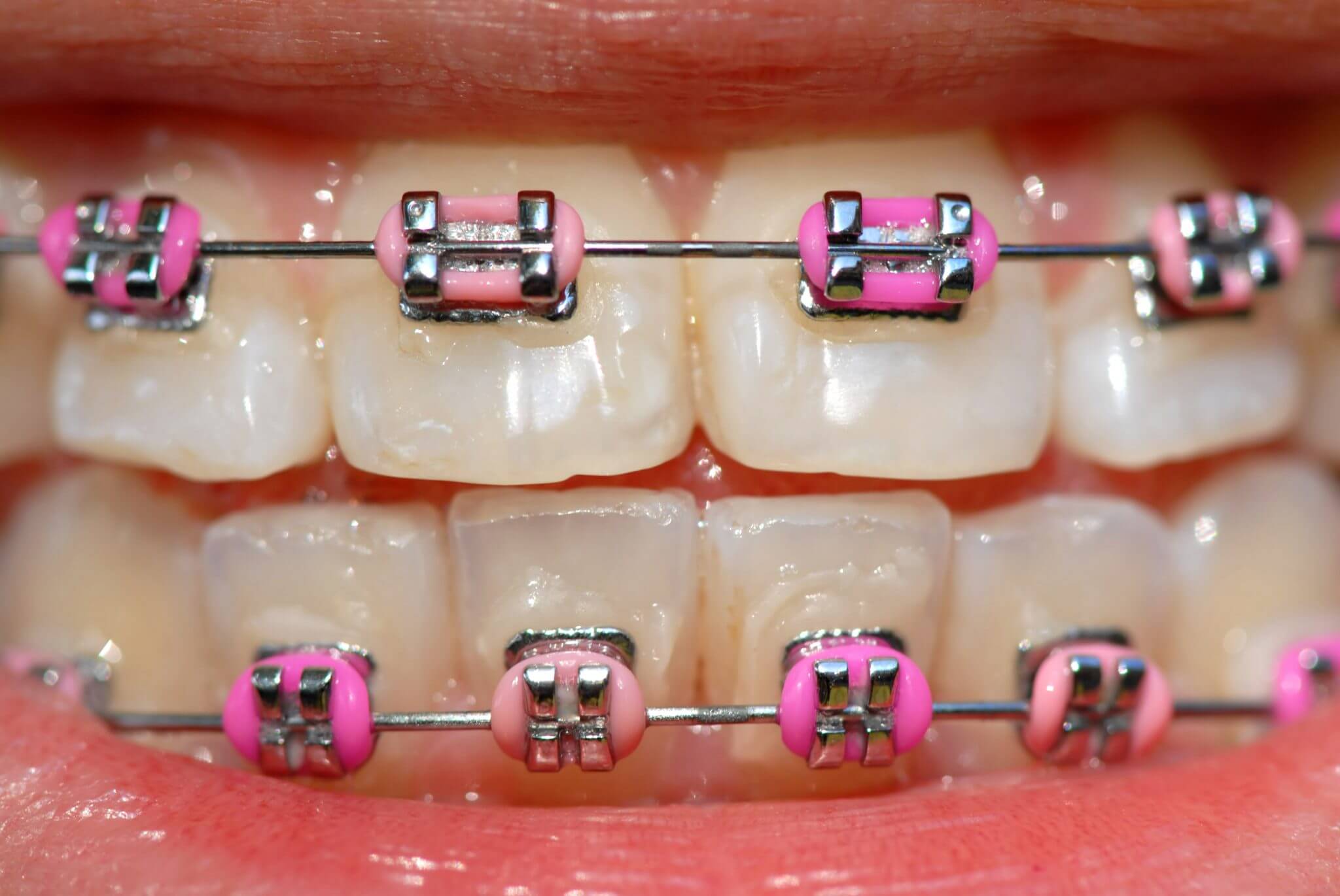 flossing with braces