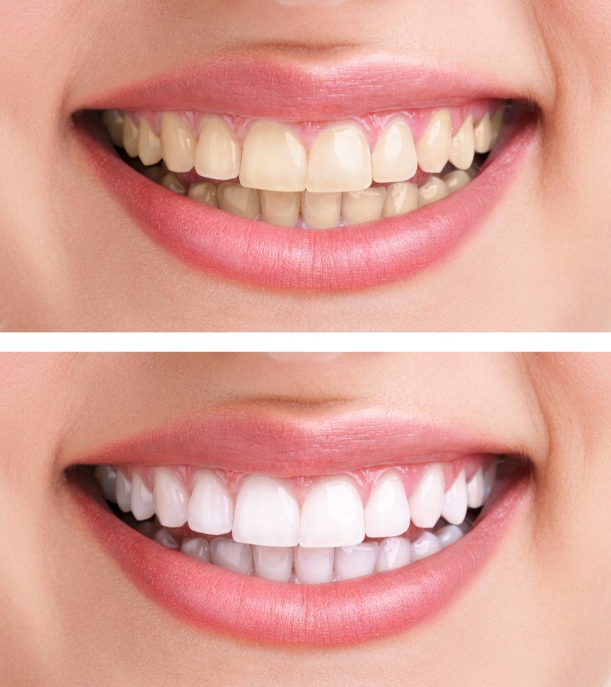 Professional Teeth Whitening Professional Teeth Whitening