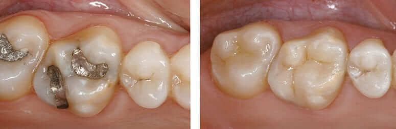 Replace Amalgam (Metal) Fillings with CEREC Crowns