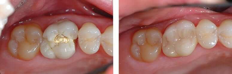 Replace Gold Filling with CEREC Crown