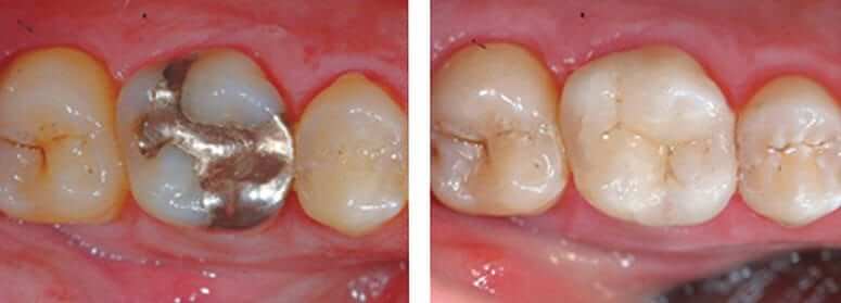 Replaced Old Amalgam Filling with CEREC Crown Onlay