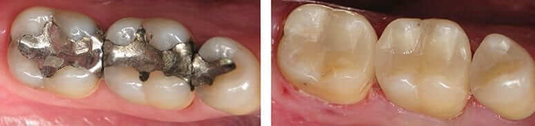 Replaced Old Amalgam Fillings with Custom CEREC Crowns