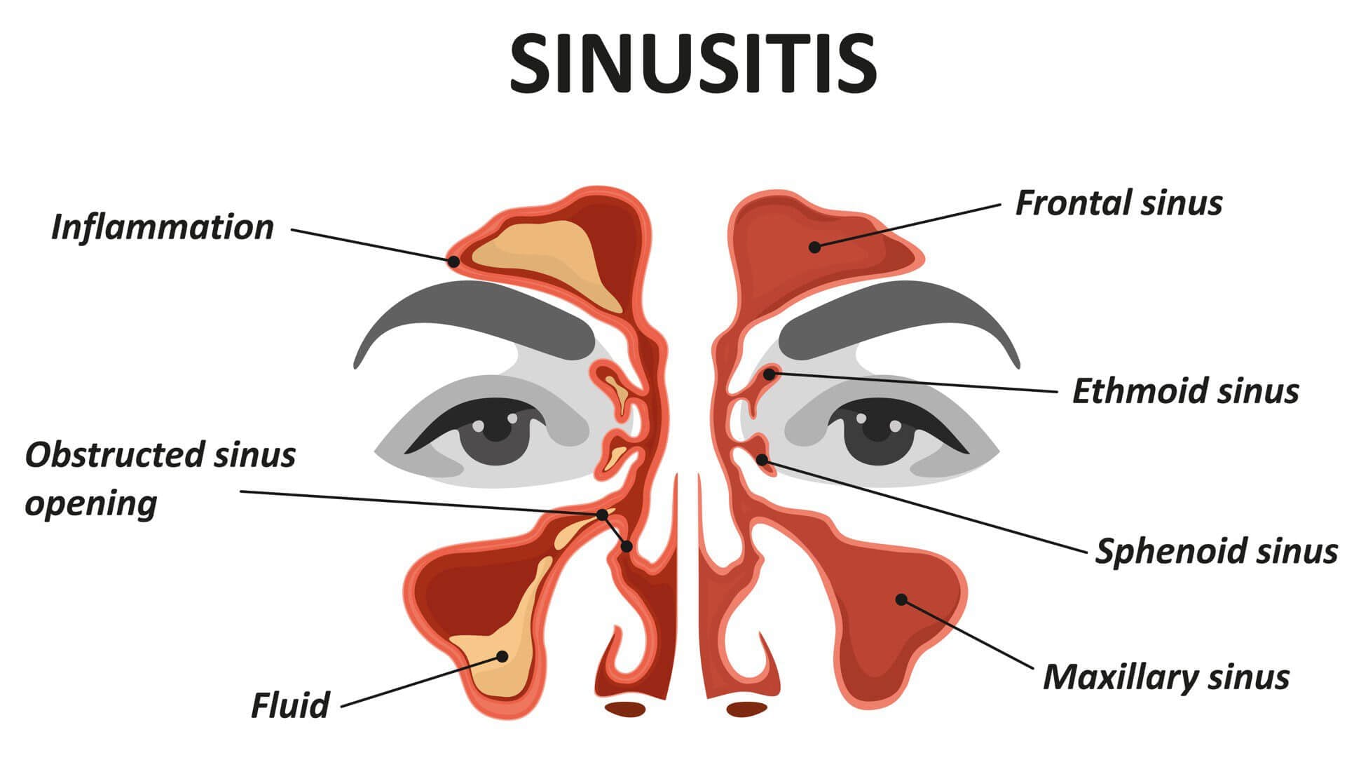 sinusitis treatment