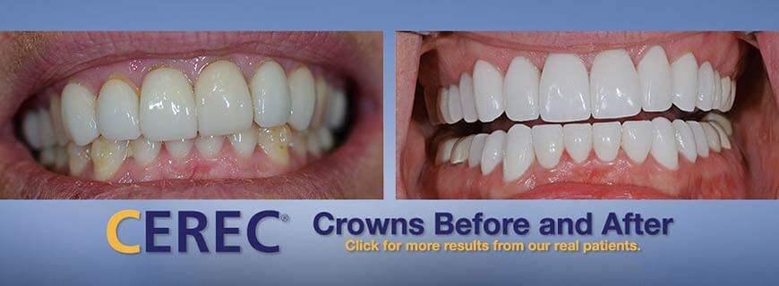 Same-Day CEREC Crowns