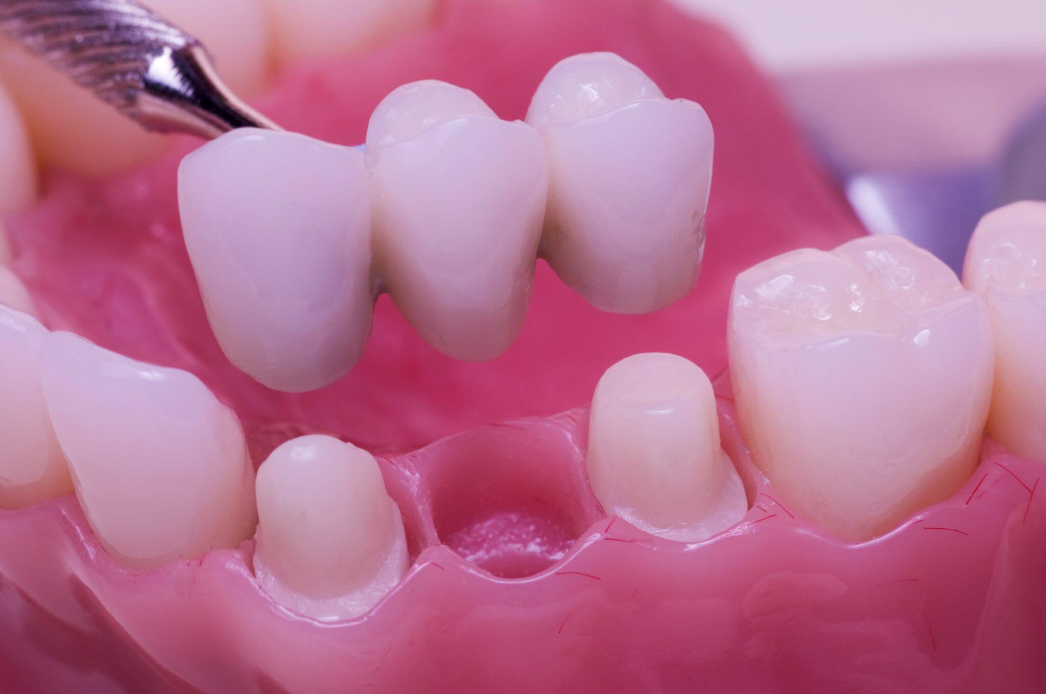 Three Unit Dental Bridge Example Three Unit Dental Bridge Example